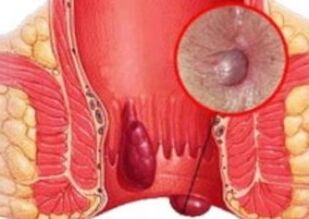How do hemorrhoids look